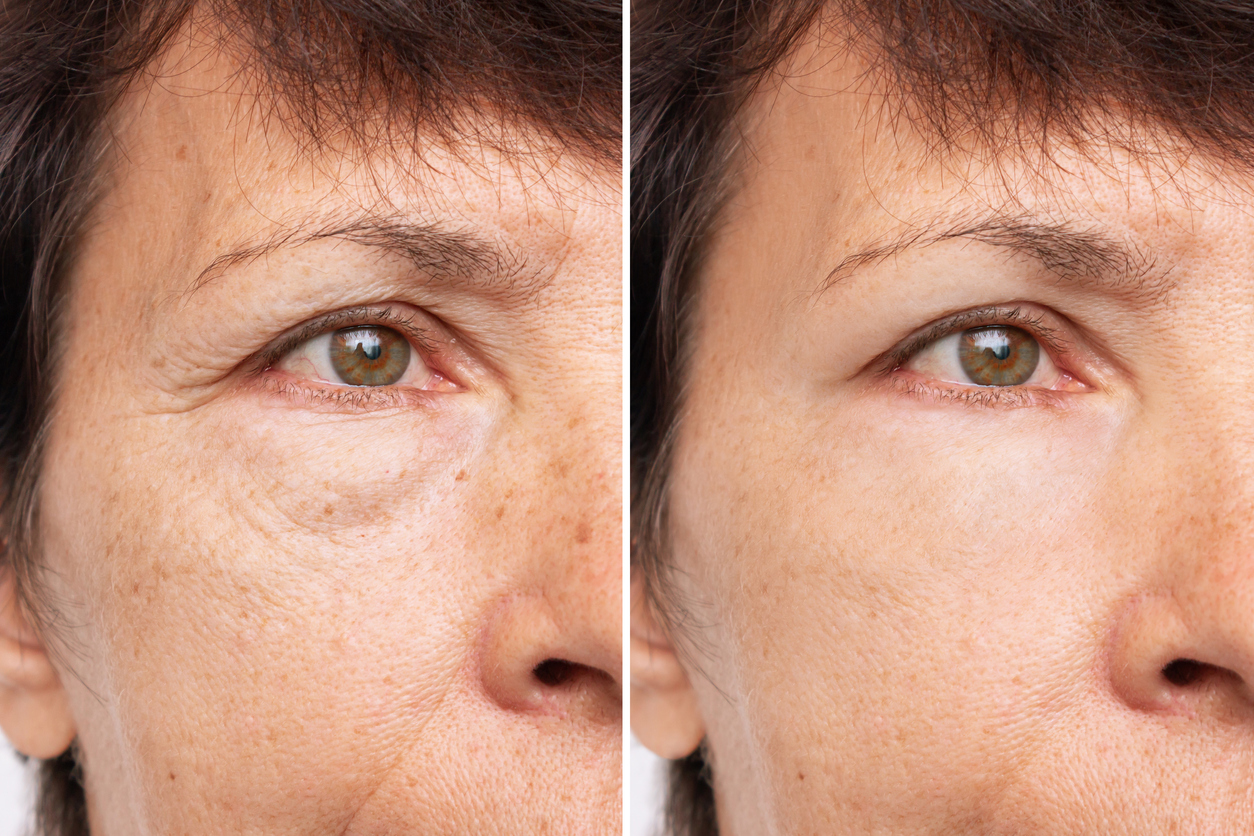 A woman’s face showcasing before and after results of under eye filler.